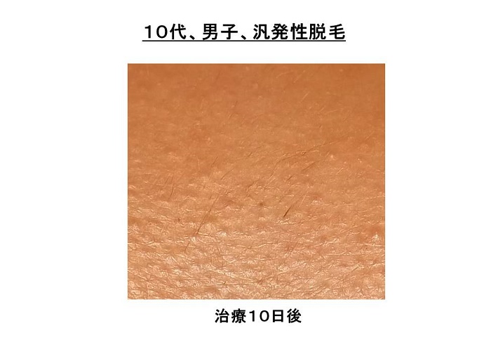 円形脱毛症　病院""